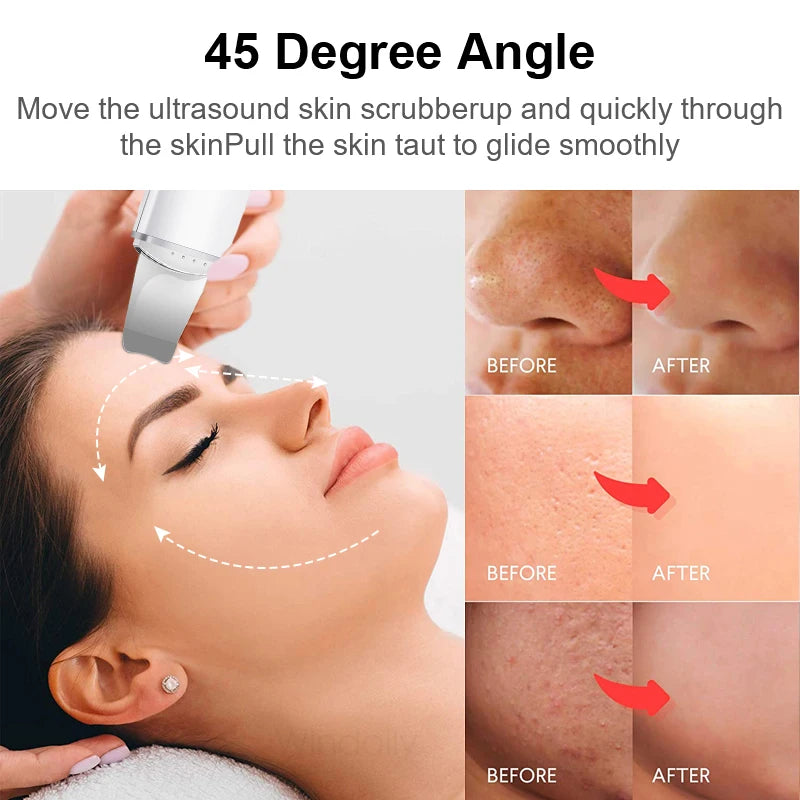 Ultrasonic Skin Scrubber Vibration Face Spatula Blackhead Remover Shovel Clean Cavitation Peeling Fa...